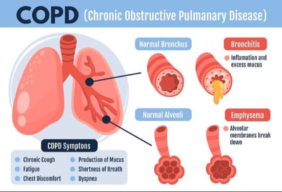 Chronic Obstructive Pulmonary Disease